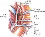胸导管损伤