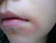 口腔科   儿科   儿科综合    疾病症状:口周湿疹的症状有:1,口唇周围