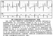 室性逸搏及室性逸搏心律