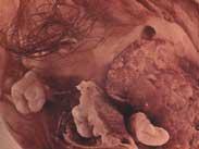 120健康网 疾病 卵巢恶性腹膜间皮瘤  上传图片 疾病别名:卵巢腹膜癌