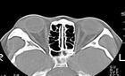 眼眶骨纤维异常增殖症