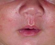 [详细] 疾病介绍:婴儿痤疮(infantileacne)又称新生儿痤疮(acne
