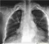 肺腫瘤