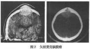 矢状窦旁脑膜瘤