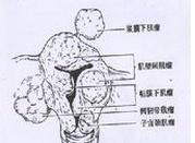 妊娠合并子宫肌瘤