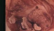 腹膜间皮瘤