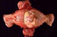 子宫颈肉瘤