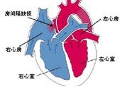 小儿房间隔缺损