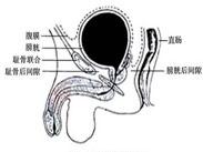 膀胱上内疝