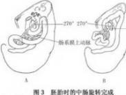 小儿肠旋转不良