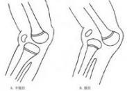 先天性膝关节脱位