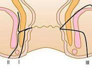 肛门周围癌