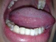 舌白斑