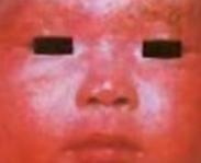 小儿面部红斑侏儒综合征