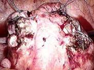 阴道子宫内膜间质肉瘤