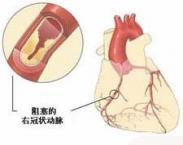 心血管和血栓栓塞综合征