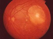 动脉阻塞或狭窄视网膜病变