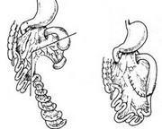 先天性小肠闭锁和肠狭窄