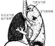 小儿单侧肺异常透亮综合征