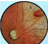 原发性视网膜脱离