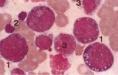 髓單核細胞白血病