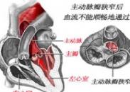 小儿先天性主动脉瓣狭窄