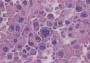 浆细胞瘤