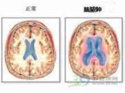 硬脑膜下脓肿