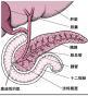 环形胰腺