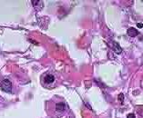 巨细胞病毒性葡萄膜炎