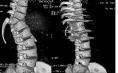 脊椎结核后突畸形