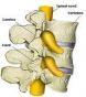 腰椎退变性小关节损伤性关节炎