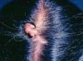 考登病中的多发性毛鞘瘤