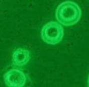 铜绿假单胞菌感染