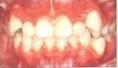 牙颌畸形