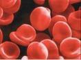 巨幼细胞性贫血