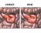 脐部脐肠系膜管息肉