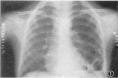 支气管肺隔离症
