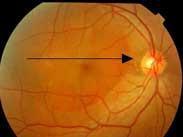 中心性浆液性脉络膜视网膜病变