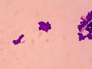 胞内分枝杆菌感染