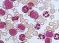 慢性粒细胞白血病