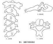 颈椎半椎体畸形