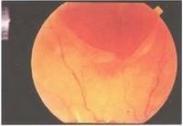 巨大裂孔性视网膜脱离