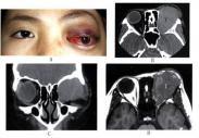 眼眶非霍奇金恶性淋巴瘤
