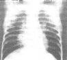 单纯性肺嗜酸性粒细胞浸润症