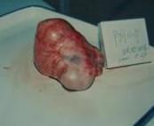 畸胎瘤