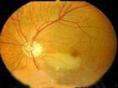 主动脉弓综合征视网膜病变