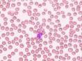 先天性红细胞生成异常性贫血