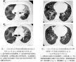 呼吸性细支气管相关的间质性肺疾病