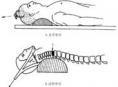 颈椎椎体楔形压缩骨折
